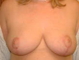 Patient # 54782 After Photo # 2