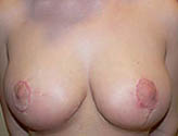 Patient # 79856 After Photo # 2