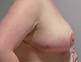 Patient # 71917 After Photo # 4