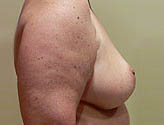 Patient # 67144 After Photo # 4