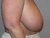 Patient # 67144 Before Photo # 3