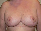 Patient # 36420 After Photo # 2
