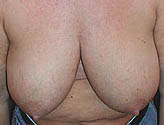 Patient # 36420 Before Photo # 1