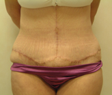 Patient # 18762 After Photo # 2