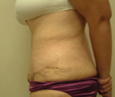Patient # 18762 After Photo # 4