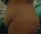 Patient # 18762 Before Photo # 3