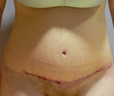 Patient # 80228 After Photo # 2