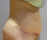 Patient # 80228 After Photo # 4