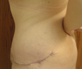 Patient # 33056 After Photo # 4