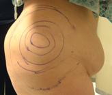 Patient # 33056 Before Photo # 3