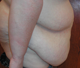 Patient # 74819 Before Photo # 3