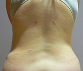 Patient # 68892 After Photo # 2