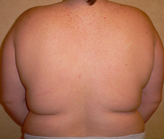 Patient # 68892 Before Photo # 1