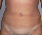 Patient # 17767 After Photo # 2