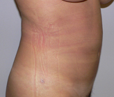 Patient # 17767 After Photo # 4