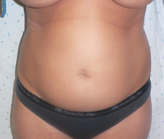 Patient # 17767 Before Photo # 1