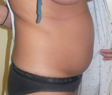 Patient # 17767 Before Photo # 3