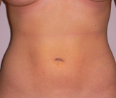 Patient # 56149 After Photo # 2