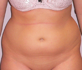 Patient # 56149 Before Photo # 1