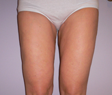 Patient # 39511 After Photo # 2
