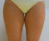 Patient # 39511 Before Photo # 1