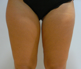 Patient # 11136 Before Photo # 1