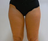 Patient # 11136 Before Photo # 3