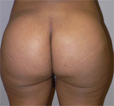 Patient # 81355 After Photo # 2