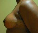 Patient # 21605 After Photo # 4