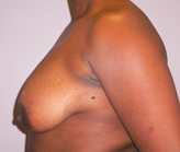 Patient # 21605 Before Photo # 3