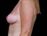 Patient # 53177 After Photo # 6