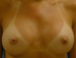 Patient # 56571 After Photo # 2