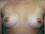 Patient # 68771 Before Photo # 1