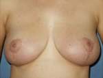 Patient # 90418 After Photo # 2