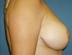 Patient # 55287 After Photo # 4