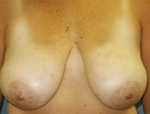 Patient # 55287 Before Photo # 1
