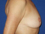Patient # 74047 After Photo # 4