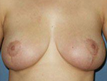 Patient # 55299 After Photo # 2