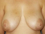 Patient # 55299 Before Photo # 1