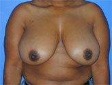 Patient # 50847 Before Photo # 1
