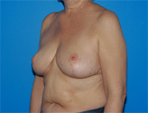Patient # 67700 After Photo # 4