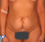 Patient # 85866 Before Photo # 1