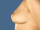 Patient # 48827 After Photo # 4