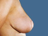 Patient # 43627 After Photo # 4