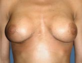 Patient # 48222 After Photo # 2