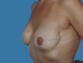Patient # 37560 After Photo # 2