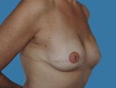Patient # 37560 After Photo # 4