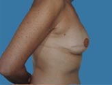 Patient # 37560 Before Photo # 3