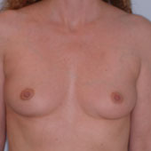 Patient # 62281 Before Photo # 1