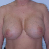 Patient # 72503 After Photo # 2